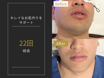 ステイゴールド 新百合ヶ丘(STAY GOLD)/おヒゲ脱毛の経過☆