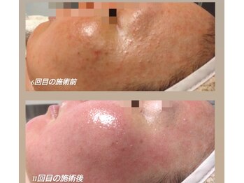 サロンド エステ ミニョン(salon de esthe mignon)/ガリレオピーリングとホームケア