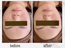 ナチュラーレ 京都四条烏丸店(Naturale)/美肌ニキビケア小顔フェイシャル