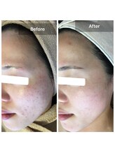 モカ 天王寺店(MOKA)/剥離ハーブピーリングニキビケア