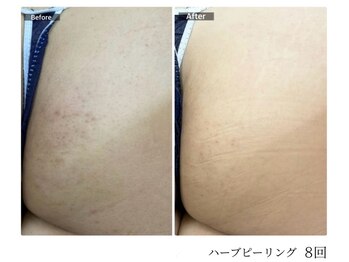 エミルカ 宮崎店(EMILUCA)/【クーポン有】お尻症例