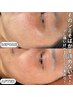 【まずはお試し♪】人気のシミケア10分×プラズマシャワー初体験コース6500円