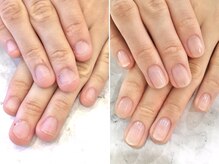 リファーレ(RIFARE)/【深爪矯正】理想の縦長美爪に♪