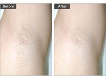 エムドゥービー(Mde`B)/スピード脱毛