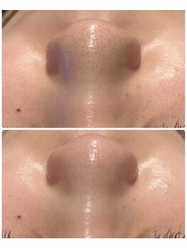 リノレア(Lino_Lea)/【大人気毛穴洗浄】