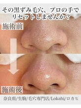 ロカヒ(Lokahi)/毛穴改善コース