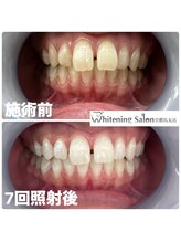 ホワイトニングサロン 京都烏丸店/ホワイトニング施術例