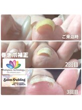 サロンドットプディング(Salon.Pudding)/３回目の巻き爪施術お客様写真