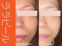 ビューティーリバース 大和店/ララピール50分