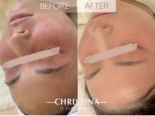 サロンブランシュ(salon BLANCHE)/赤みの鎮静・水分補給◎