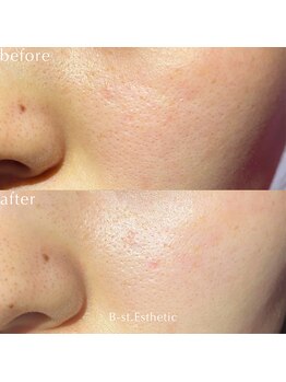 ビースト 下北沢店(B-st.)/フェイシャル｜全顔1回