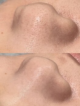 インパクトビューティー 問屋町(IMPACT BEAUTY)/鼻の毛穴もお任せください!