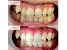 【医療提携】セルフホワイトニングで自信のある口元を叶えます