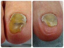 あし処 トコトコ(tocotoco)/爪甲剥離