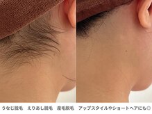 ピュアノア 垂水店/えりあし脱毛　神戸垂水明石