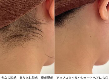 ピュアノア 垂水店/えりあし脱毛　神戸垂水明石