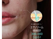 ピービー(PB)/メソプロ（MESOPRO+）