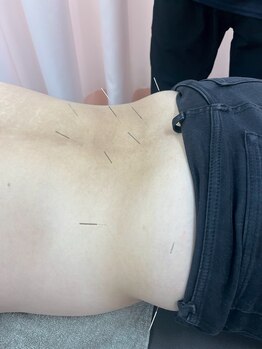 あい鍼灸院 接骨院 イオンモール仙台上杉院/鍼やってみませんか?