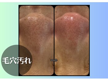 ラヴェンナサロン トウキョウ(Ravenna Salon Tokyo)/ハーブピーリング+毛穴ケア♪