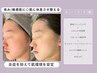 【花粉/敏感肌/肌回復】bebeレストセルトリートメント120分￥17,000