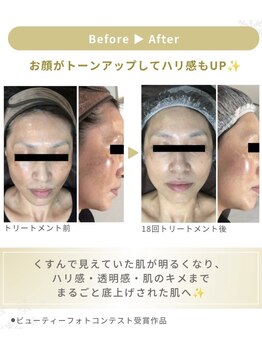 private salon SORA/輝きを育む幹細胞ピーリング