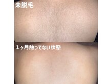 エピジュ(Epijyu)/女性の背中脱毛