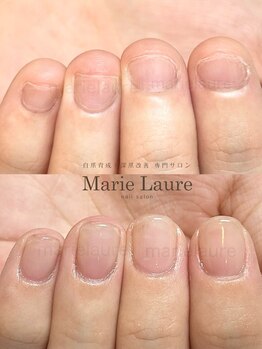 マリーロール 淀屋橋本店(Marie Laure)/自爪育成/深爪矯正/ネイルケア