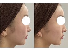 レイジュ(reiju)/サーモシェイプ　フェイシャル