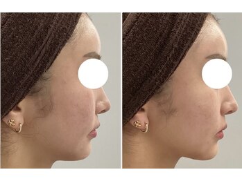 レイジュ(reiju)/サーモシェイプ　フェイシャル