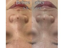 ラ ミュエル(La miel)/毛穴洗浄／５月から１２月