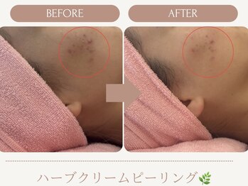 シルク(Cilk)/ハーブクリームピーリング