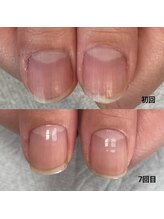 ルアナ(LUANA)/自爪育成お客様ビフォーアフター