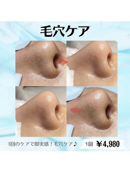 リノミラ(LINOMIRA)/脱毛ついでに毛穴ケア　毛穴洗浄