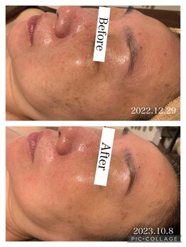 ナビ(NABI)/ハーブピーリング☆板橋/REVI