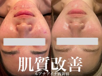 ルアナアイナ(Luana Aina)/ハーブピーリングでニキビケア