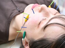 鍼灸院くろえ 大阪江坂/美容鍼◎