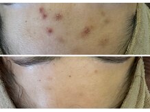 ベル(Belle)/ハイドロ/美白ケアにも最適！