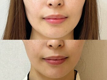 リリーベル 新宿歌舞伎町(Lily Belle)の写真/<全室完全個室>小顔効果実感！《ベルリフト》で映えるフェイスラインに♪ほうれい線,もたつき,たるみケア◎