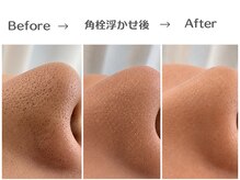 エスポワール(espoir)/専用の美容液で角栓を浮かし除去