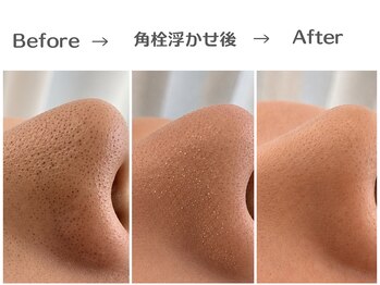 エスポワール(espoir)/専用の美容液で角栓を浮かし除去