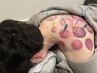 鍼灸 90分【鍼で首、肩、頭メイン&吸い玉も可　お悩みに合わせた鍼灸施術 】