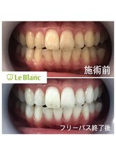ルブラン 奈良店(Le Blanc)/絶対来て欲しいホワイトニング