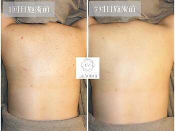 ラヴィオーラ 加古川店(La Viora)/ダイヤモンドハーブピーリング