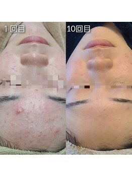 リンド(Lindo)/ハーブトリートメント