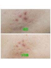 エターナル(Eternal)/ハーブピーリングで赤み撃退！