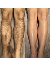 メンズ脱毛 ジョルジオ(GIORGIO)/脚の脱毛　ビフォーアフター7回