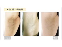 ル シェリア(Le Cherien)/抜群の脱毛効果★