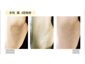 ル シェリア(Le Cherien)/抜群の脱毛効果★