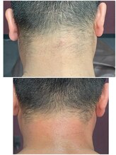 グロー(GLOW)/Wax脱毛