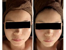 ラグーン(Lagoon)/WINBACK小顔矯正コルギ＋ヘッド.